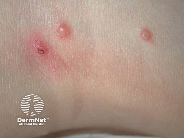 Molluscum contagiosum