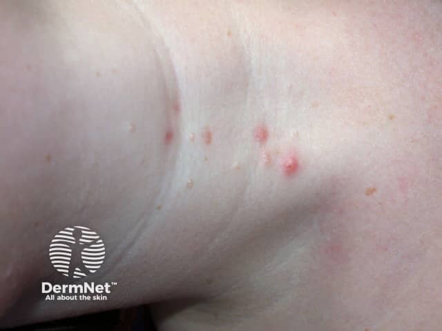 Molluscum contagiosum