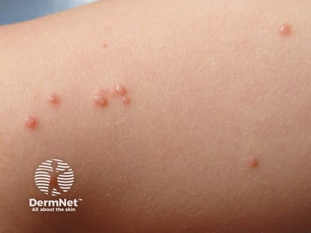 Molluscum contagiosum