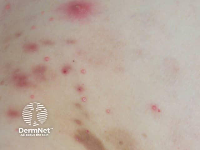 Molluscum contagiosum