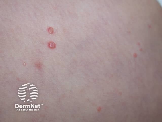 Molluscum contagiosum