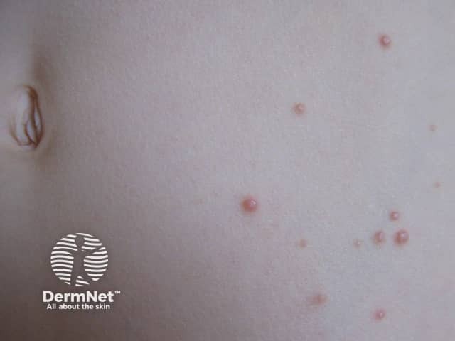 Molluscum contagiosum