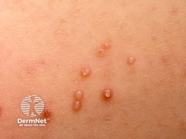 Molluscum contagiosum