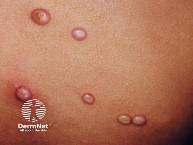 Molluscum contagiosum