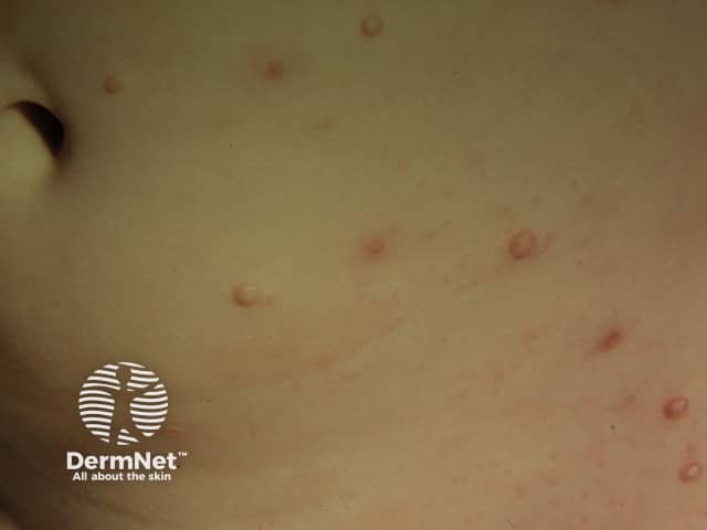 Molluscum contagiosum