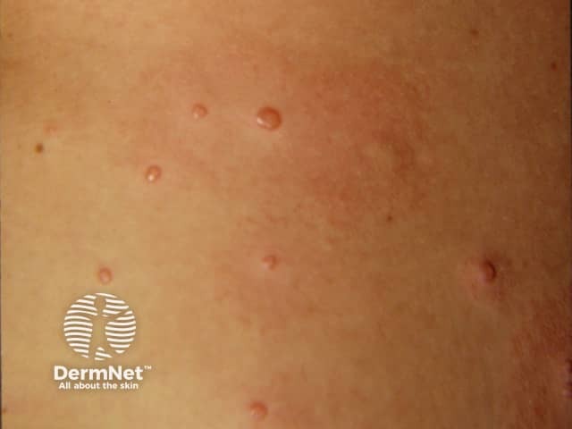 Molluscum contagiosum