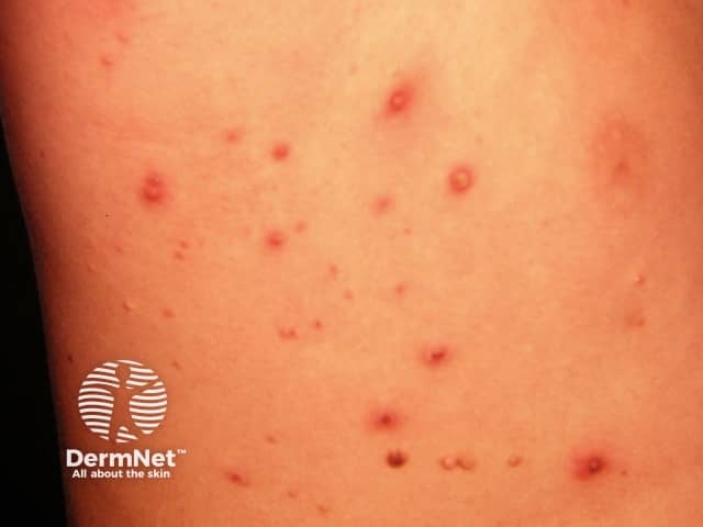 Molluscum contagiosum