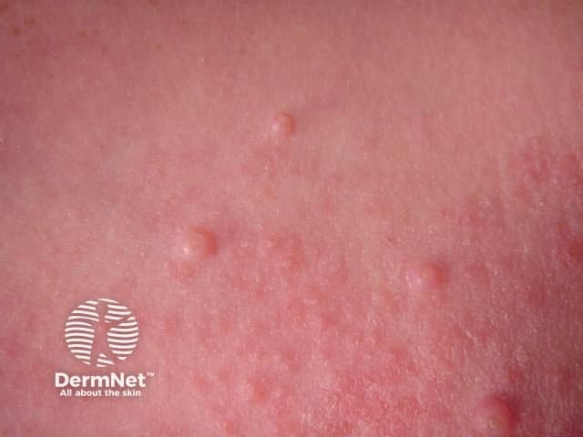 Molluscum contagiosum