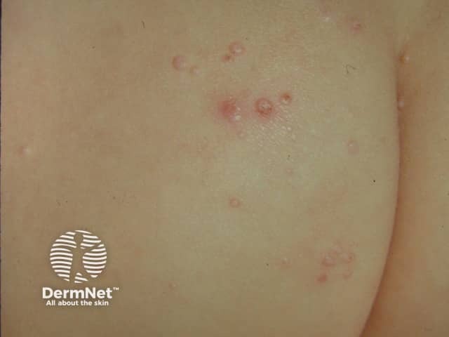 Molluscum contagiosum