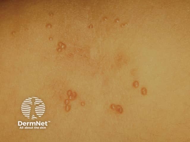 Molluscum contagiosum