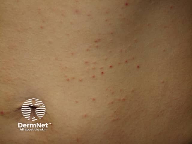 Molluscum contagiosum