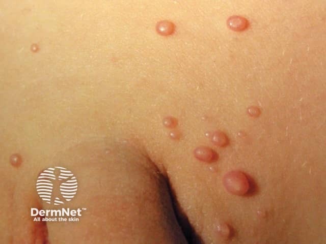 Molluscum contagiosum