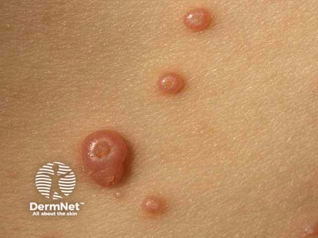 Molluscum contagiosum