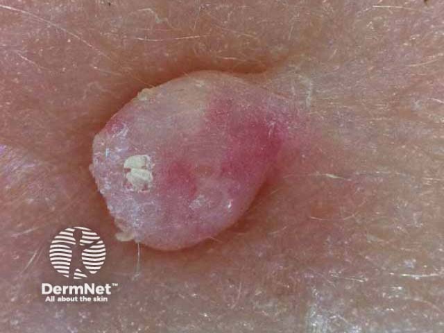 Molluscum contagiosum