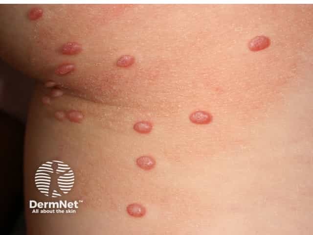 Molluscum contagiosum