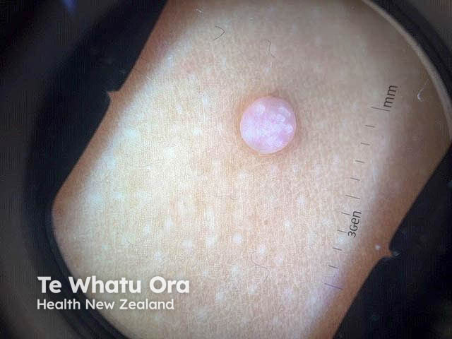 Dermatoscopic image of molluscum contagiosum