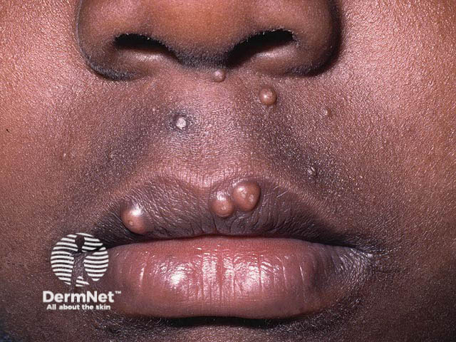 Pearly perioral umbilicated papules of molluscum contagiosum