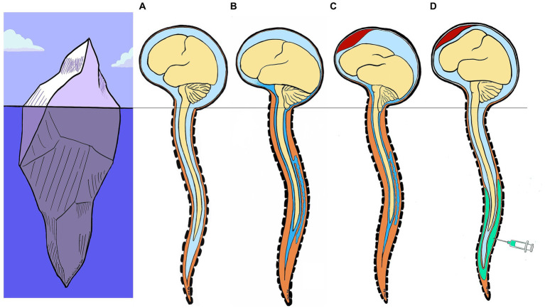 An external file that holds a picture, illustration, etc.
Object name is fneur-15-1308462-g004.jpg