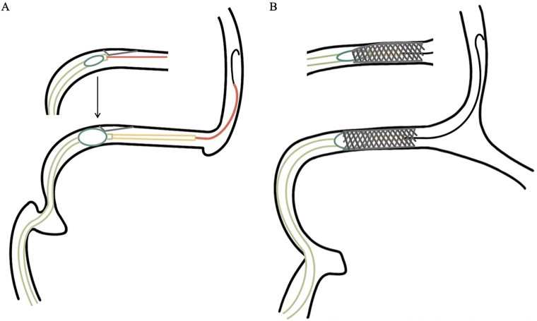 An external file that holds a picture, illustration, etc.
Object name is 10.1177_15910199241289458-fig1.jpg