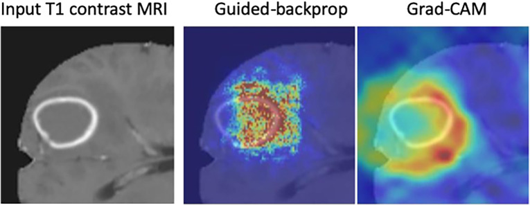 Examples of interpretability methods used on medical images. (a) Guided backpropagation and gradient-weighted class activation mapping (Grad-CAM) used on MRI to interpret areas of a brain image used by a deep learning model classifying the input image as a high-grade glioma. (Adapted and reprinted, with permission, from reference 7). Importance of pixels are color-coded as red = high importance, blue = low importance. (b) Regression concept vectors used to assess relevance of selected features describing curvature, tortuosity, and dilatation of retinal arteries and veins from retinal images, analyzed by a deep convolutional neural network. In b, examples of a correctly and wrongly classified image are shown, allowing the interpretation that the network is more sensitive to curvature and dilatation concepts for the classification of normal images, while being more sensitive to tortuosity for disease images. (Adapted and reprinted, with permission, from reference 6). Avg = average, cti = cumulative tortuosity index, Pn, Ppre, Pplus = network probabilities for normal, pre, and pre-plus classes.