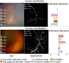 Examples of interpretability methods used on medical images. (a) Guided backpropagation and gradient-weighted class activation mapping (Grad-CAM) used on MRI to interpret areas of a brain image used by a deep learning model classifying the input image as a high-grade glioma. (Adapted and reprinted, with permission, from reference 7). Importance of pixels are color-coded as red = high importance, blue = low importance. (b) Regression concept vectors used to assess relevance of selected features describing curvature, tortuosity, and dilatation of retinal arteries and veins from retinal images, analyzed by a deep convolutional neural network. In b, examples of a correctly and wrongly classified image are shown, allowing the interpretation that the network is more sensitive to curvature and dilatation concepts for the classification of normal images, while being more sensitive to tortuosity for disease images. (Adapted and reprinted, with permission, from reference 6). Avg = average, cti = cumulative tortuosity index, Pn, Ppre, Pplus = network probabilities for normal, pre, and pre-plus classes.