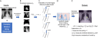 A, Local interpretable model-agnostic explanations (LIME) method approximates a complex model f (eg, a neural network) with a simplified model g (eg, linear model) around the input case I being interpreted. B, Perturbed instances (Ip)1,...,n are produced, and C, predictions f(Ip)1,...,n = p1,...,n are obtained. D, The similarity  I(Ip)1,...,n between the input image I and each perturbed instance (Ip)1,...,n is measured, and these values are used as weights to fit a simpler (eg, linear) model g, in a weighted fashion. The size of red crosses and blue circles illustrates weights. E, An explanation,  (I), is generated by minimizing the disagreement between f and g (ie, how well g approximates f) while keeping the complexity of model g, as measured by  (g), low. Note: Perturbations can be of any type; in this example, image regions are blacked out. The similarity metric  I as well as the model g can be selected by the user.