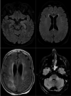 Axial FLAIR in four different COVID-19 patients. A) 58-year old man with impaired consciousness: FLAIR hyperintensities located in the left medial temporal lobe. B) 66-year old man with impaired consciousness: FLAIR ovoid hyperintense lesion located in the central part of the splenium of the corpus callosum. C) 71-year old woman with pathological wakefulness after sedation: extensive and confluent supratentorial white matter FLAIR hyperintensities (arrows). Association with leptomeningeal enhancement (stars) D) 61-year old man with confusion: hyperintense lesions involving both middle cerebellar peduncles.