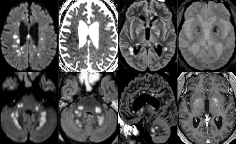 65-year old man with pathological wakefulness after sedation. Non-confluent multifocal white matter hyperintense lesions on FLAIR and diffusion, with variable enhancement, and hemorrhagic lesions. Axial Diffusion (A, B), Apparent Diffusion Coefficient (ADC) map (C), axial FLAIR (D, E), sagittal FLAIR (F), axial Susceptibility weighted imaging (SWI) (G), and postcontrast T1 weighted MR images (H). Multiple nodular hyperintense Diffusion and FLAIR lesions localized in the white matter including the corpus callosum (F). Some of them (white arrow) are associated with reduced ADC corresponding to cytotoxic edema (C). Other lesions are located next to the lenticular nucleus (cross) (E, G, H), with hemorrhagic changes (G), and enhancement after contrast administration.