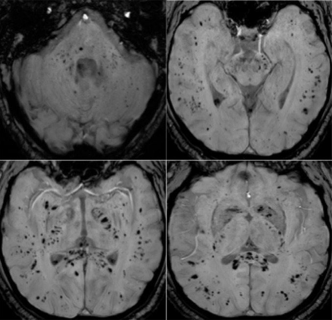 57-year old man with pathological wakefulness after sedation. Extensive and isolated white matter microhemorrhages. Axial Susceptibility weighted imaging (SWI) (A, B, C, D): multiple microhemorrhages mainly affecting the subcortical white matter, corpus callosum, internal capsule, and cerebellar peduncles.