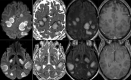 54-year old man with pathological wakefulness after sedation. Non-confluent multifocal white matter hyperintense lesions on FLAIR and diffusion, with variable enhancement. Axial Diffusion (A, B), Apparent Diffusion Coefficient (ADC) map (C, D), axial postcontrast FLAIR (E, F), and postcontrast T1 weighted MR images (G, H). Multiple nodular hyperintense Diffusion and FLAIR subcortical and corticospinal tracts lesions, with very mild mass effect on adjacent structures. The lesions present a center with an elevation of ADC corresponding to vasogenic edema and a peripheral ring of reduced ADC corresponding to cytotoxic edema (C, D). After contrast administration, small areas of very mild enhancement are detected (G, H).