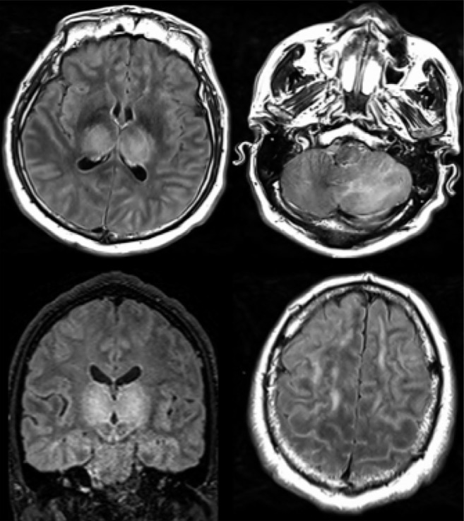 51-year old man with impaired consciousness. Acute necrotizing encephalopathy. Axial FLAIR (A, C, D), and coronal FLAIR (B): bilateral FLAIR hyperintensity (cross) in both thalami (A, B), associated with involvement of the cerebellar (C), and cerebral (D) white matter (arrows).