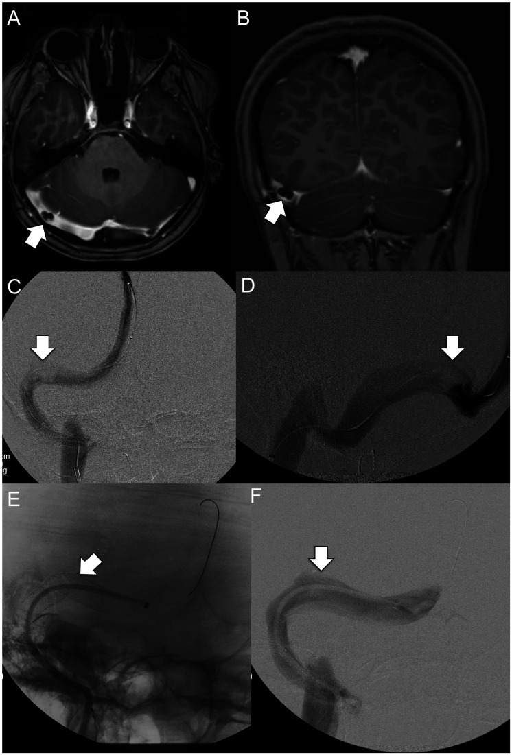 An external file that holds a picture, illustration, etc.
Object name is 10.1177_1591019920976234-fig1.jpg