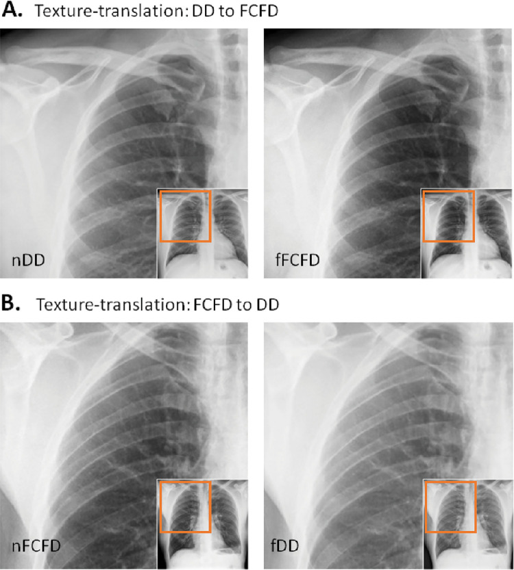 Texture translation between radiographs from different manufacturers. A, Texture translation from the Philips DigitalDiagonost (DD) to the Siemens Fluorospot Compact FD (FCFD) with the original (left) and its corresponding fake (right) chest radiograph, shows between-manufacturer changes occurring at high spatial frequencies, with global thoracic structures hardly altered. B, Texture translation from the FCFD to the DD. fDD = fake DD image, fFCFD = fake FCFD image, nDD = native DD image, nFCFD = native FCFD image.