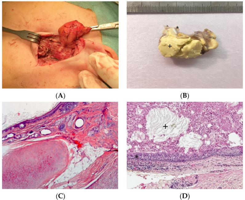 An external file that holds a picture, illustration, etc.
Object name is dermatopathology-08-00039-g003a.jpg