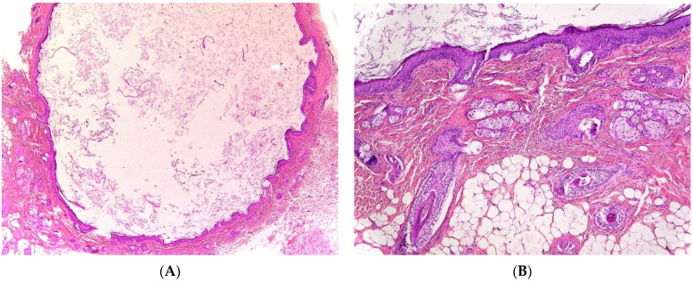 An external file that holds a picture, illustration, etc.
Object name is dermatopathology-08-00039-g005a.jpg