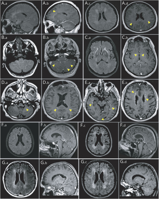 An external file that holds a picture, illustration, etc.
Object name is NEUROLOGY2021172684F2.jpg