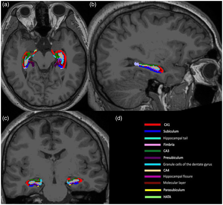 An external file that holds a picture, illustration, etc.
Object name is 10.1177_19714009211049078-fig1.jpg