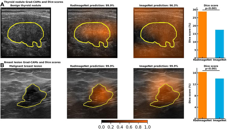 Visualizations of gradient-weighted class activation maps (Grad-CAMs) from accurately predicted images and Dice scores from the quantitative Grad-CAMs. The first column demonstrates the original image and the ground truth. The second and third columns show the Grad-CAMs from a RadImageNet model and an ImageNet model, respectively. The fourth column represents the average Dice score of 24 simulated RadImageNet and ImageNet models, with the error bar showing SDs. (A) A benign thyroid nodule. Both RadImageNet and ImageNet models accurately predicted the characteristics of this benign nodule, with the confidence of 99.9% and 96.3%, respectively. RadImageNet models achieved a Dice score of 28.8%, while ImageNet models had a Dice score of 17.5% (P   .001). (B) A malignant breast lesion. Both RadImageNet and ImageNet models accurately captured this malignant lesion, with confidence of 99.9% and 99.9%, respectively. RadImageNet models illustrated a 16.3% Dice score, outperforming ImageNet models, which showed a Dice score of 14.0% (P   .001). Two-sided P values for comparing the Dice scores were calculated by paired t test.