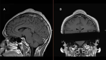 An MRI of a breaker&#x27;s head shows the tumor that doctors believe developed due to repeated headspins. BMJ Case Reports 2024