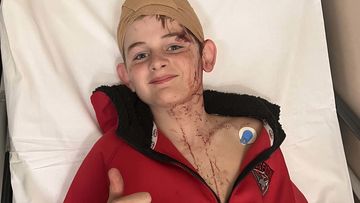 Phoenix, 12, was attacked by a big male kangaroo at home in Victoria.