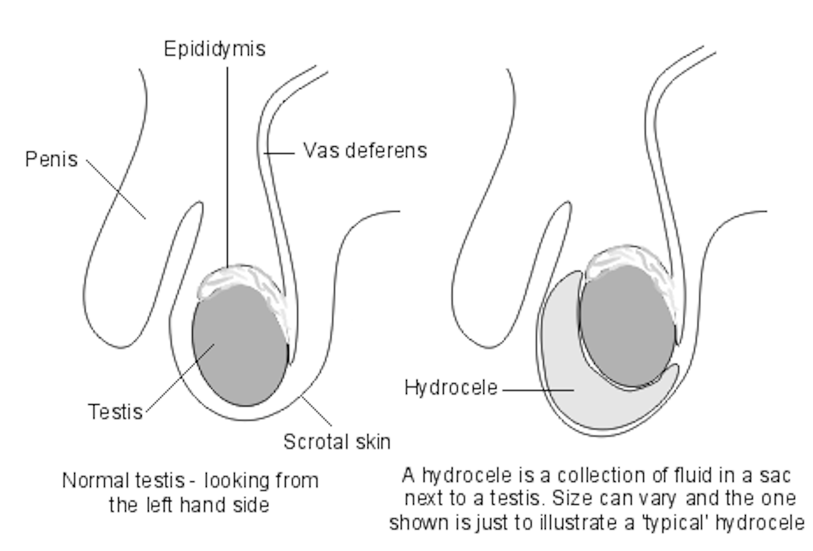 Hydrocele