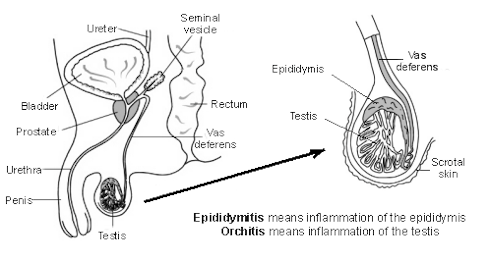 Testis with explanation of epididymitis and orchitis