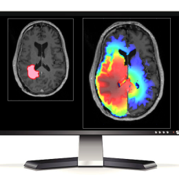 Personalised treatment planning for stereotactic radiotherapy of high-grade glioma